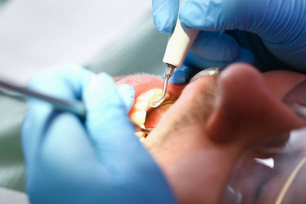 Best Chipped Tooth Repair Near Me  in Redwood, OR